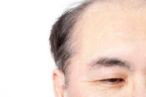 男性の髭脱毛も可能な船橋のクリニック